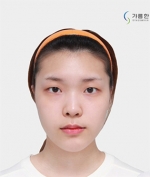 GYALUMHAN Plastic Surgery,Reviews,Images, Promotions — Korea cost, reviews & before-after | MISOODA