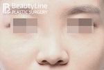 Beauty Line Plastic Surgery,Reviews,Images, Promotions — Korea cost, reviews & before-after | MISOODA