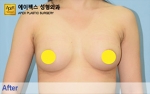 breast
