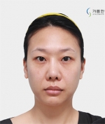 GYALUMHAN Plastic Surgery,Reviews,Images, Promotions — Korea cost, reviews & before-after | MISOODA