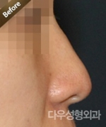 Rhinoplasty