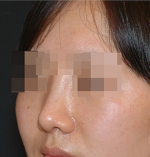 Rhinoplasty
