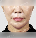 face lift