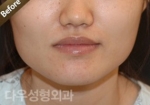 facial contouring