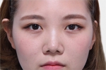 GYALUMHAN Plastic Surgery,Reviews,Images, Promotions — Korea cost, reviews & before-after | MISOODA