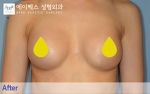 breast