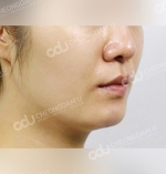 face lift