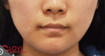 Glovi Plastic Surgery, Reviews, Images, Promotions, Dr. Rho Bongil, Dr. Nam Sangjae, Dr. Park Jongchul — Korea cost, reviews & before-after | MISOODA