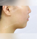 facial contouring