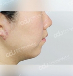 facial contouring