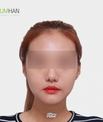 GYALUMHAN Plastic Surgery,Reviews,Images, Promotions — Korea cost, reviews & before-after | MISOODA
