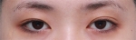 GYALUMHAN Plastic Surgery,Reviews,Images, Promotions — Korea cost, reviews & before-after | MISOODA