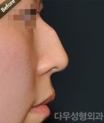 Rhinoplasty