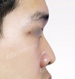 Rhinoplasty