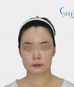 GYALUMHAN Plastic Surgery,Reviews,Images, Promotions — Korea cost, reviews & before-after | MISOODA