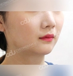 facial contouring