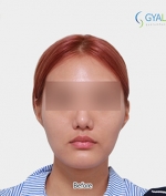 GYALUMHAN Plastic Surgery,Reviews,Images, Promotions — Korea cost, reviews & before-after | MISOODA
