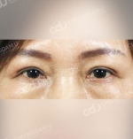 eye surgery