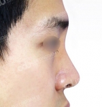 Rhinoplasty