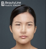 Beauty Line Plastic Surgery,Reviews,Images, Promotions — Korea cost, reviews & before-after | MISOODA
