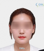 GYALUMHAN Plastic Surgery,Reviews,Images, Promotions — Korea cost, reviews & before-after | MISOODA