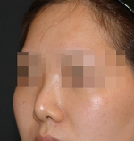 Rhinoplasty