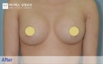 breast