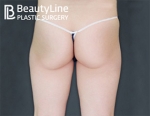 Beauty Line Plastic Surgery,Reviews,Images, Promotions — Korea cost, reviews & before-after | MISOODA