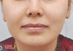 Glovi Plastic Surgery, Reviews, Images, Promotions, Dr. Rho Bongil, Dr. Nam Sangjae, Dr. Park Jongchul — Korea cost, reviews & before-after | MISOODA