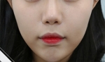 Glovi Plastic Surgery, Reviews, Images, Promotions, Dr. Rho Bongil, Dr. Nam Sangjae, Dr. Park Jongchul — Korea cost, reviews & before-after | MISOODA