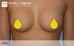 breast