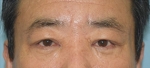 face lift
