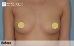 breast