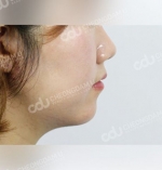 facial contouring