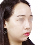 facial contouring