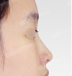 Rhinoplasty