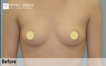 breast