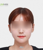 GYALUMHAN Plastic Surgery,Reviews,Images, Promotions — Korea cost, reviews & before-after | MISOODA