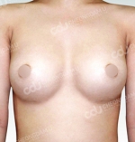 breast