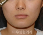 facial contouring