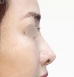 Rhinoplasty