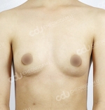 breast