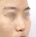 Rhinoplasty