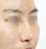 Rhinoplasty