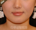 facial contouring