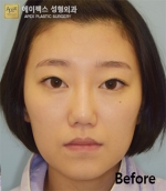 face lift