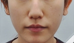 Glovi Plastic Surgery, Reviews, Images, Promotions, Dr. Rho Bongil, Dr. Nam Sangjae, Dr. Park Jongchul — Korea cost, reviews & before-after | MISOODA