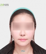 GYALUMHAN Plastic Surgery,Reviews,Images, Promotions — Korea cost, reviews & before-after | MISOODA