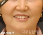 face lift