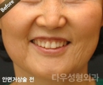face lift